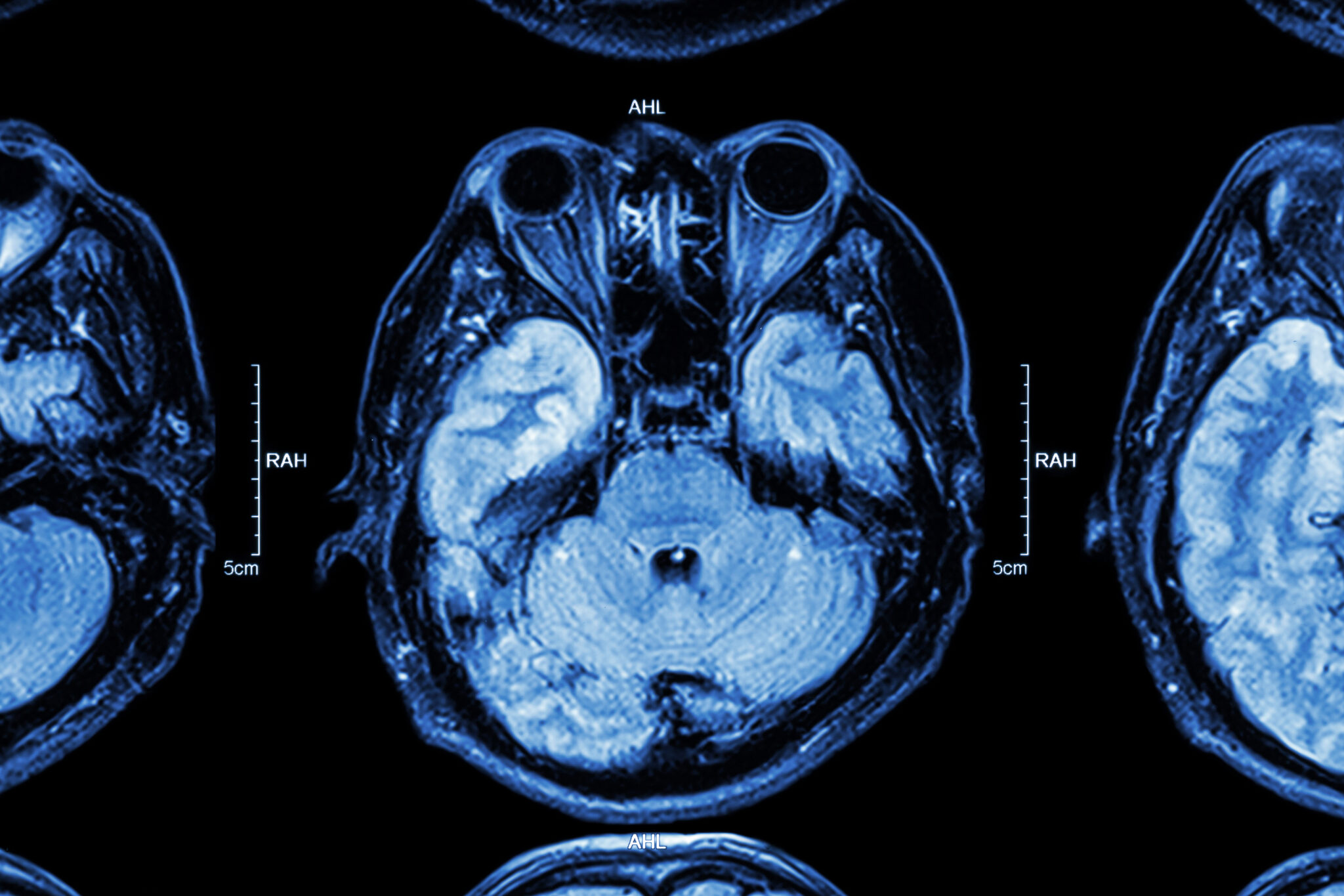 Neurosurgery types of brain surgery