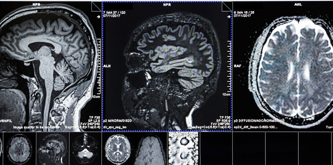 Neurosurgery and Spine