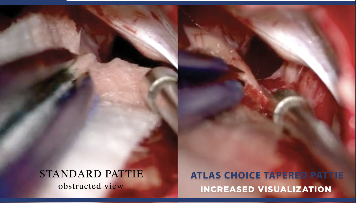 Atlas Choice™ Tapered Neuro Pattie 4